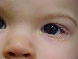 vệ sinh cho bé 1 tuổi bị đau mắt đỏ