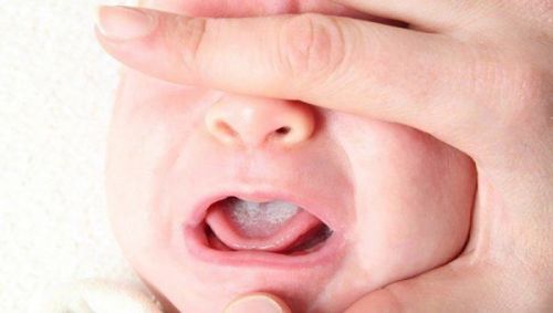 trẻ sơ sinh bị trắng lưỡi