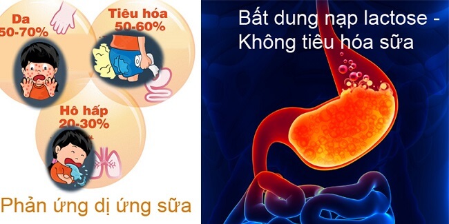 Bất dung nạp lactose ở trẻ